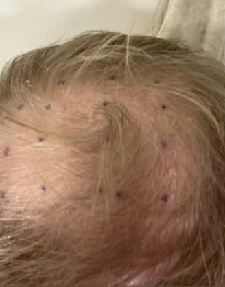 Before direct injections: light-haired scalp viewed from above