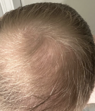 After direct injections: light-haired scalp viewed from above