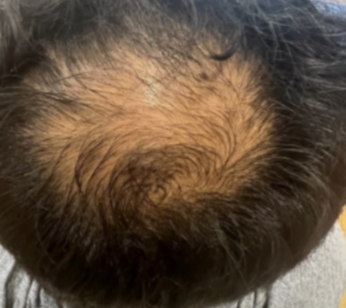 Before direct injections: dark-haired crown viewed from above