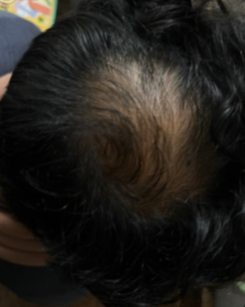 After direct injections: dark-haired crown viewed from above