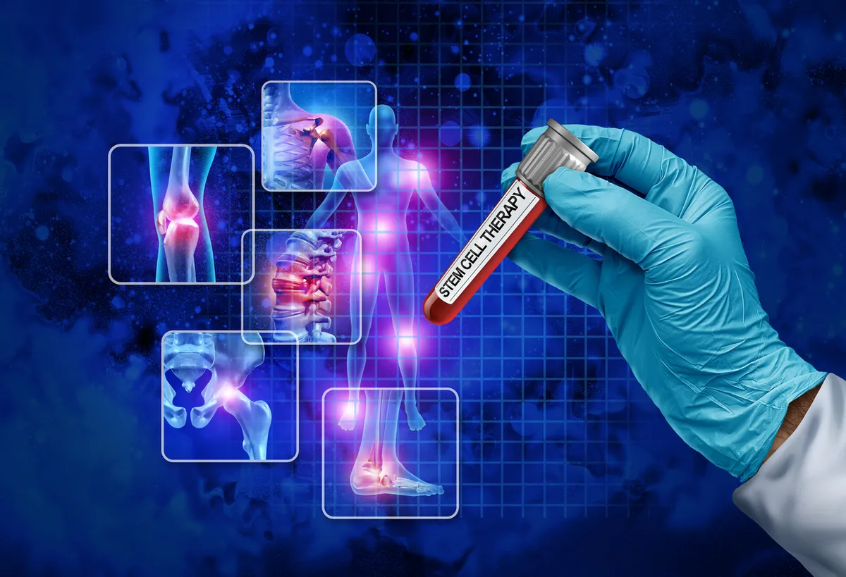 A gloved hand holding a labeled stem cell therapy vial, with highlighted joints illustrated behind it